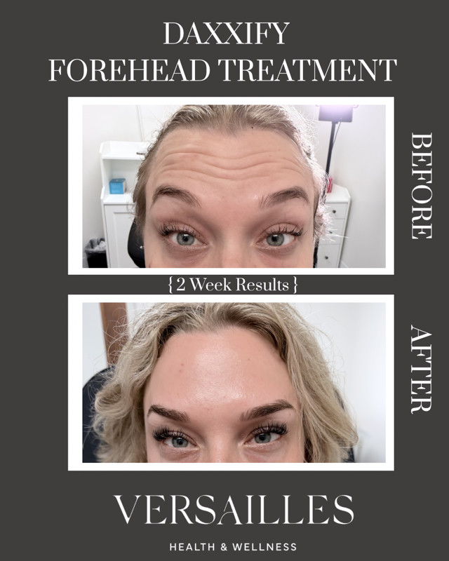 DAXXIFY forehead treatment before and after — 2 week results at Versailles Health and Wellness