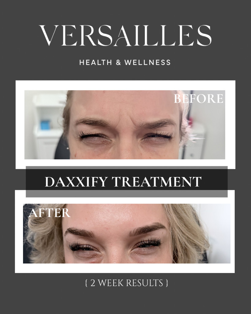 DAXXIFY treatment before and after — 2 week results at Versailles Health and Wellness